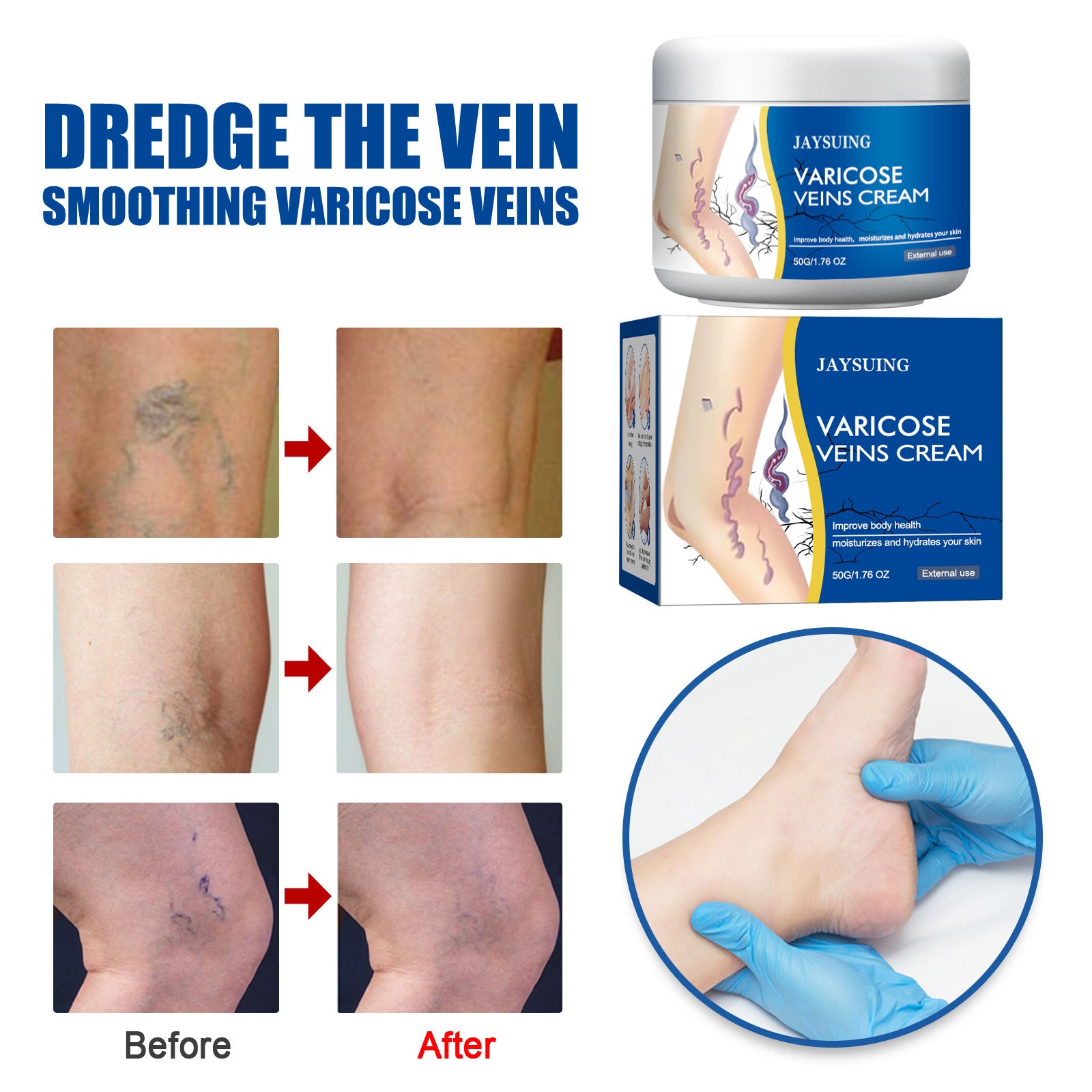 Leg Vein Repair Cream Varicose Massage Earthworm Legs